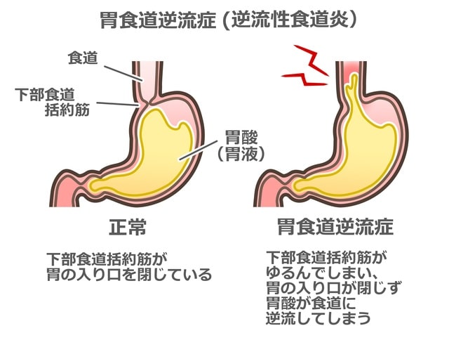 逆流性食道炎とは